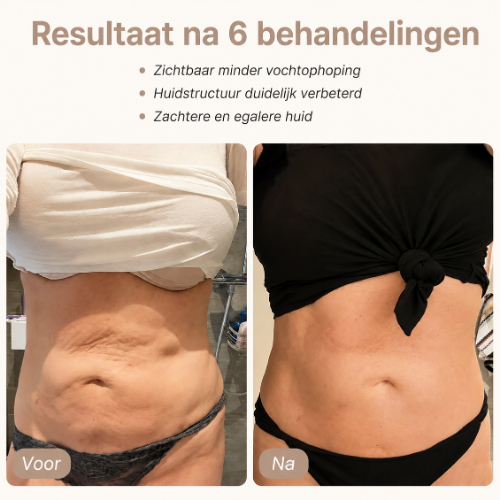 Velivio CellaGlide - Anti-Cellulite & Body Shaping Massage Apparaat